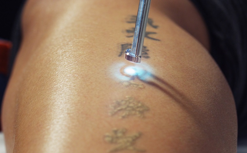 Laserowe usuwanie tatuażu alternatywą dla chirurgicznej interwencji. Fotografia: montanalaserdoc.com.