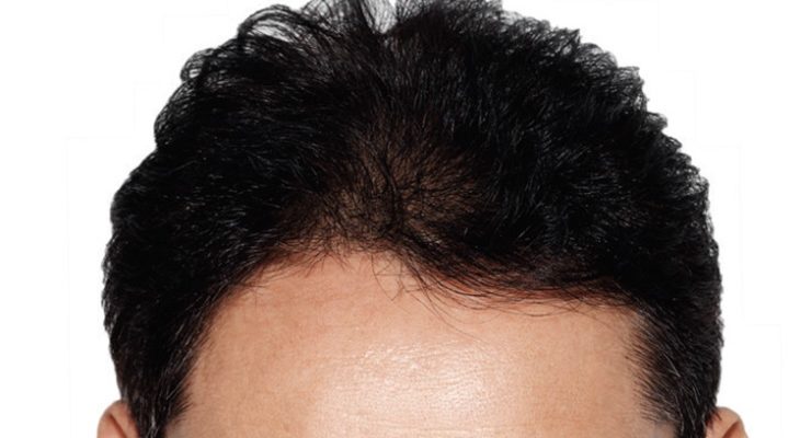 Zabieg transplantacji włosów inwazyjną metodą leczenia łysienia. Fotografia: cdn.expatwoman.com.