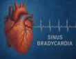 przyczyny, objawy i ewentualne leczenie bradykardii zatokowej - spowolnionego rytmu pracy serca